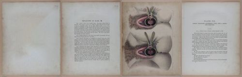 E345 - Illustrations of Syphilitic - i11889-11890-11891