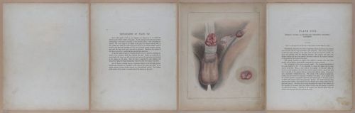 E345 - Illustrations of Syphilitic - i11897-11898-11899
