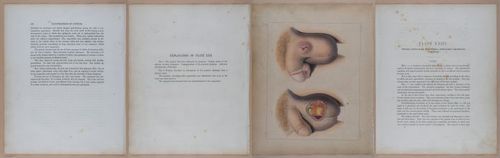 E345 - Illustrations of Syphilitic - i12008-12009-12010-12011