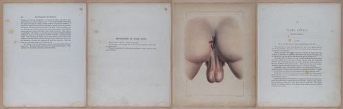 E345 - Illustrations of Syphilitic - i12037-12038-12039-12040