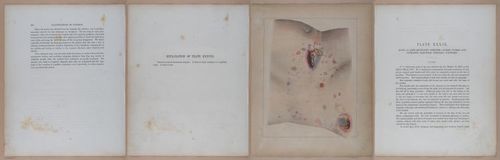 E345 - Illustrations of Syphilitic - i12101-12102-12103-12104