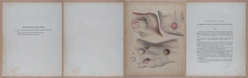 E345 - Illustrations of Syphilitic - i12109-12110-12111
