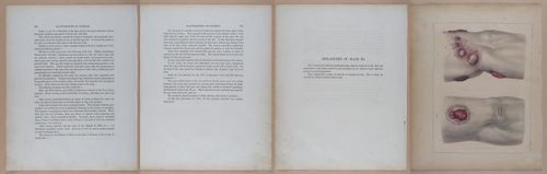 E345 - Illustrations of Syphilitic - i12112-12113-12114-12115